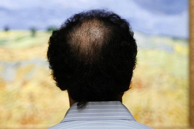 ‘crown Baldness Associated With Higher Risk Of Heart Disease Analysis